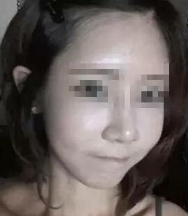 假體隆鼻+面部填充手術(shù)20天康復(fù)記錄