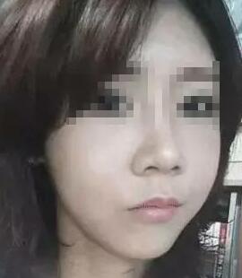 假體隆鼻+面部填充手術(shù)20天康復(fù)記錄