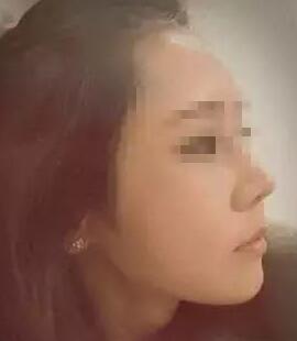 假體隆鼻+面部填充手術(shù)20天康復(fù)記錄