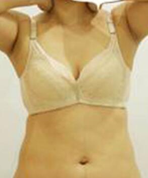 腰部吸脂 水桶腰變成小蠻腰啦