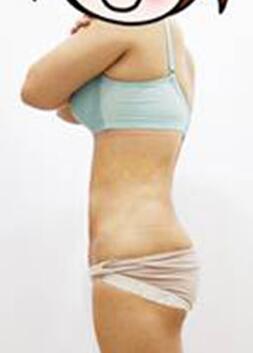 腰部吸脂 水桶腰變成小蠻腰啦