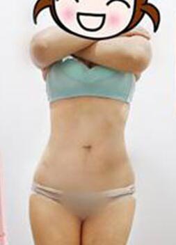 腰部吸脂 水桶腰變成小蠻腰啦