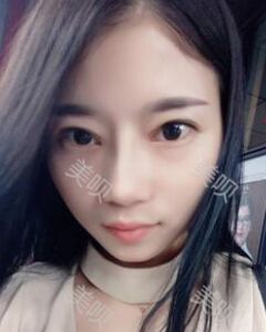 張中鋒做的隆鼻整形真的精致漂亮