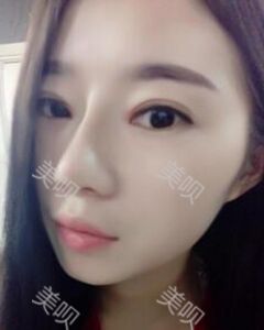 張中鋒做的隆鼻整形真的精致漂亮