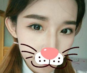 鄭東學(xué)做的雙眼皮果你來評(píng)價(jià)