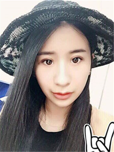 大家看看盧剛給我做的膨體墊下巴怎么樣