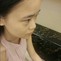 自體脂肪隆鼻之后恢復(fù)得很好果超自然的