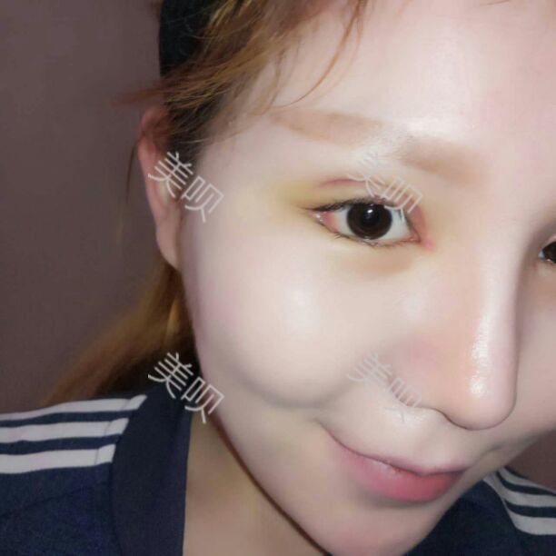 面部吸脂瘦臉后讓我從大餅?zāi)樧兂闪税驼菩臉