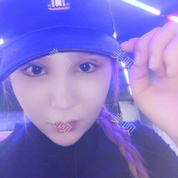 面部吸脂瘦臉后讓我從大餅?zāi)樧兂闪税驼菩臉