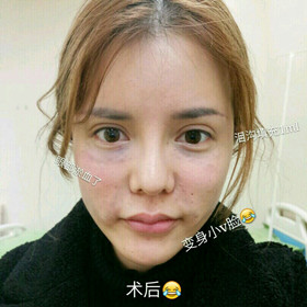 埋蛋白線.提升面部對比圖片，顏值嘩嘩嘩的往上漲!!!