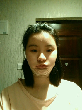 自體脂肪填充下巴前后對比圖，進來看看就知道啦!