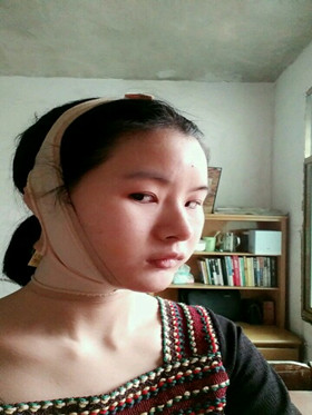 自體脂肪填充下巴前后對比圖，進來看看就知道啦!