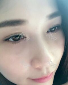 在廣州締妍做了內(nèi)切去眼袋后年輕多了