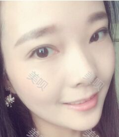 激光去眼袋后終于讓我的大眼袋消失了