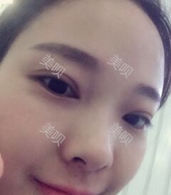 激光去眼袋后終于讓我的大眼袋消失了