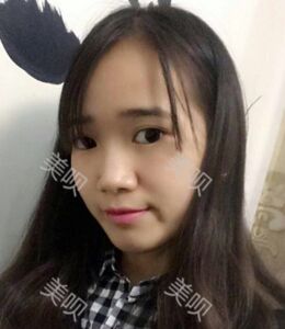 全切雙眼皮帶給我超自然的美麗雙眼