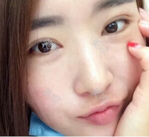 煙臺(tái)鵬愛做的雙眼皮宛如天生