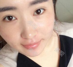 煙臺(tái)鵬愛做的雙眼皮宛如天生