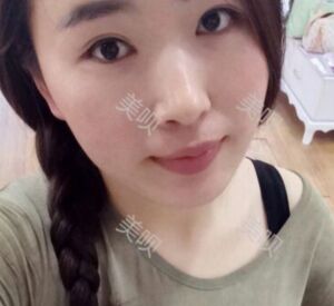 煙臺(tái)鵬愛做的雙眼皮宛如天生