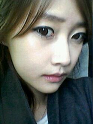 終于做了下頜角磨骨的手術(shù) 北京藝星做的 果還不錯(cuò)