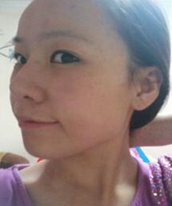 北京301醫(yī)院做下頜角整形果對(duì)比圖開(kāi)來(lái)圍觀啊