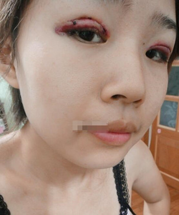 你們來看看藝美門智和做的埋線雙眼皮，瞬間變大眼美女