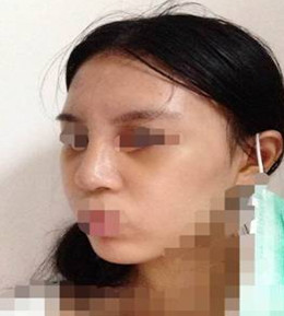 藝美門智和綜合隆鼻，你值得擁有