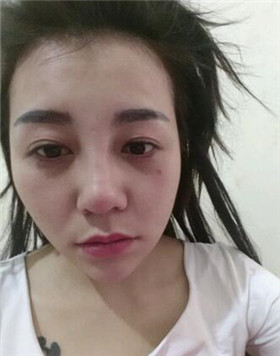 來評價一下華美劉琦做的高強度聚焦超聲吧