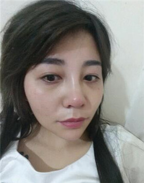 來評價一下華美劉琦做的高強度聚焦超聲吧