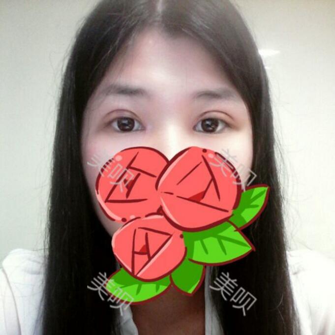 我做了切開雙眼皮術(shù)后果很好哦