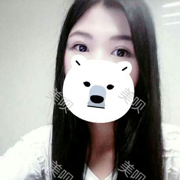 我做了切開雙眼皮術(shù)后果很好哦