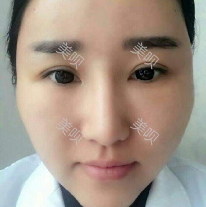 自體脂肪豐太陽穴后整個臉變得好有立體感太美了