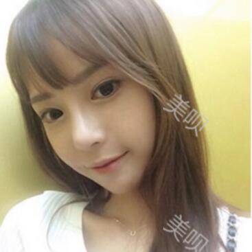 硅膠假體隆鼻后我基本的甩掉了我的駝峰鼻