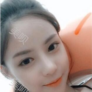 硅膠假體隆鼻后我基本的甩掉了我的駝峰鼻