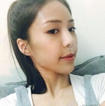 硅膠假體隆鼻后我基本的甩掉了我的駝峰鼻