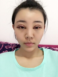 開(kāi)外眼角手術(shù)前后過(guò)程對(duì)比圖片