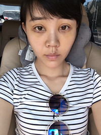 開(kāi)外眼角手術(shù)前后過(guò)程對(duì)比圖片