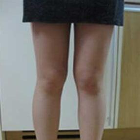 北京禾美嘉大腿吸脂 給大家分享一下體驗