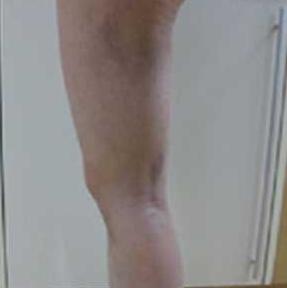 北京禾美嘉大腿吸脂 給大家分享一下體驗