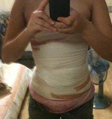 北京禾美嘉腹部吸脂 可以自信地秀出小蠻腰啦！