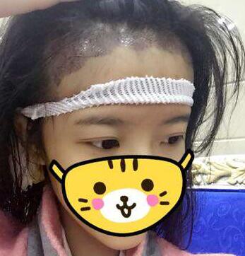 成都玉之光發(fā)際線(xiàn)種植 果不錯(cuò)~