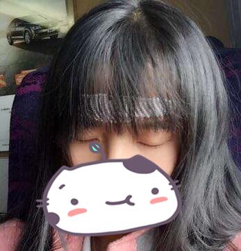 成都玉之光發(fā)際線(xiàn)種植 果不錯(cuò)~