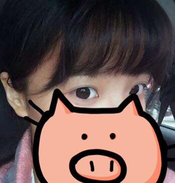 成都玉之光發(fā)際線(xiàn)種植 果不錯(cuò)~