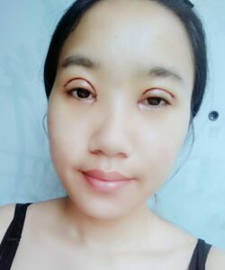 煙臺(tái)鵬愛(ài)魏璐做的全切雙眼皮，我也是大眼美女了