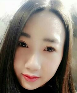 煙臺(tái)鵬愛(ài)魏璐做的全切雙眼皮，我也是大眼美女了