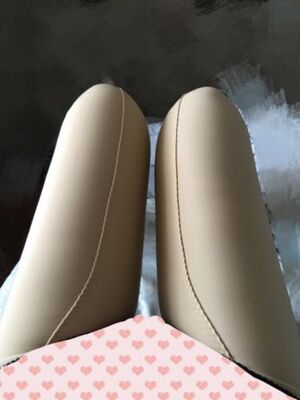 擺脫大粗腿做了大腿抽脂，煙臺(tái)鵬愛(ài)魏璐做的