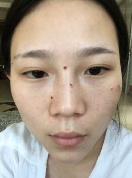 激光去雀斑后皮膚干凈白皙多了，青島華韓汪曉波做的