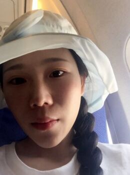 激光去雀斑后皮膚干凈白皙多了，青島華韓汪曉波做的