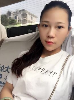 激光去雀斑后皮膚干凈白皙多了，青島華韓汪曉波做的