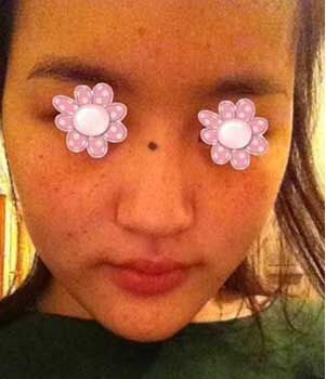 激光去雀斑把我遺傳性的雀斑給全部去掉啦